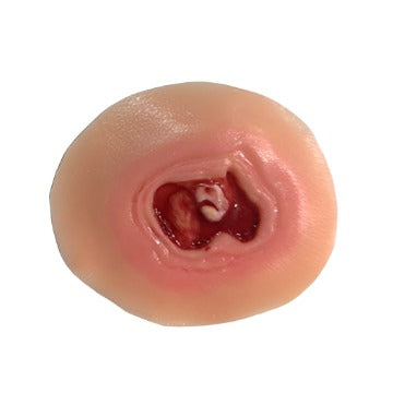 Diabetic Ulcer 20 Mm