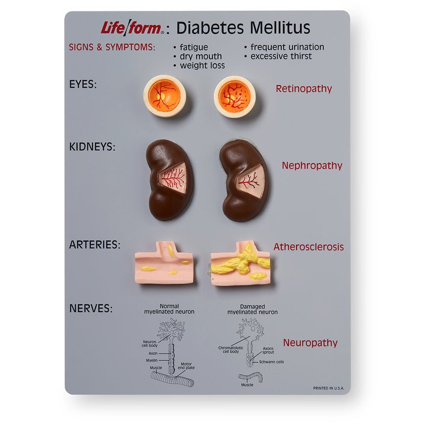  Nasco Healthcare-Life/form® Diabetes Mellitus Teaching Kit-MedTech-1