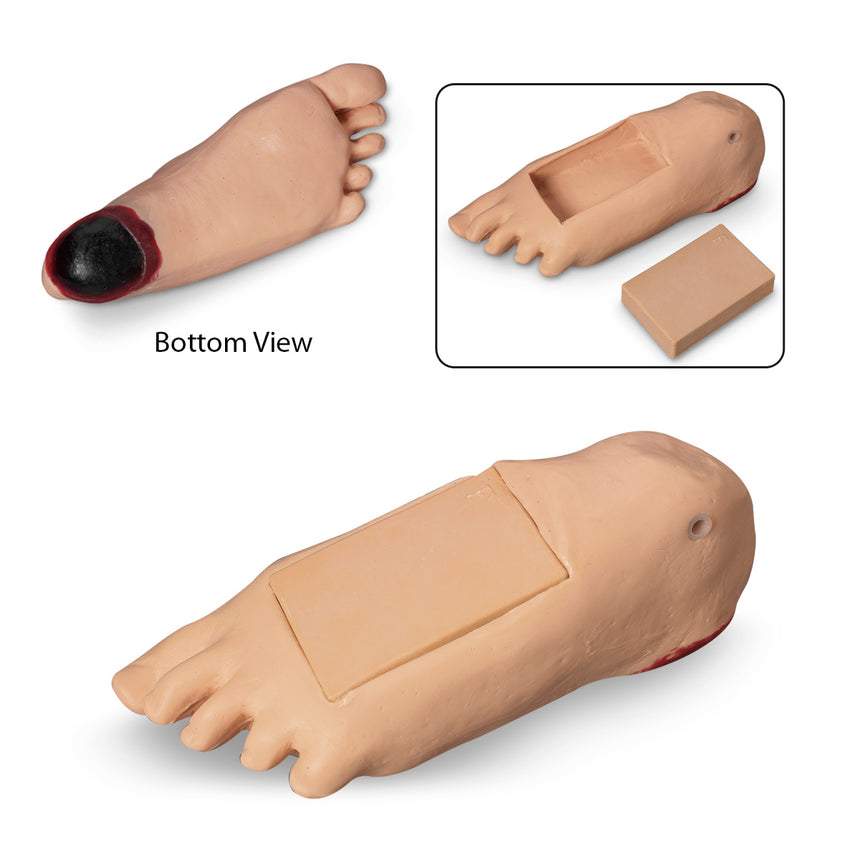 Life/form® GERi and KERi Optional Edema Foot with Deep Tissue Injury - Light