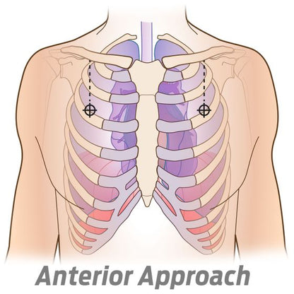 SPEAR - SIMPLIFIED PNEUMOTHORAX EMERGENCY AIR RELEASE