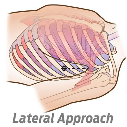 SPEAR - SIMPLIFIED PNEUMOTHORAX EMERGENCY AIR RELEASE